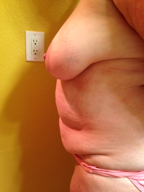 Before surgery left side.JPG